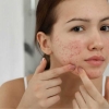 Cirurgia da Acne x Espremer Espinhas