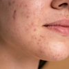 Bactérias inteligentes para tratar acne