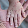 Mão-Pé-Boca: saiba como identificar e prevenir