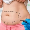 Lipoaspiração emagrece?