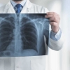 Entenda o que é pneumonia silenciosa